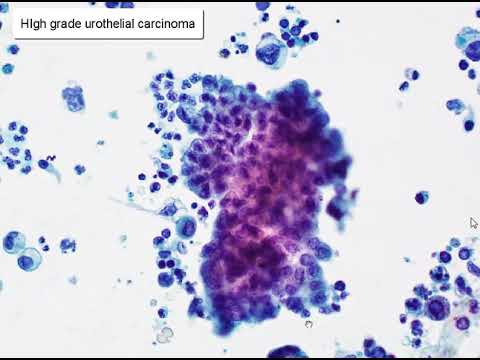 Urine: Polyoma Virus and Urothelial Carcinoma