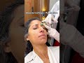 PRP Therapy For Face 
