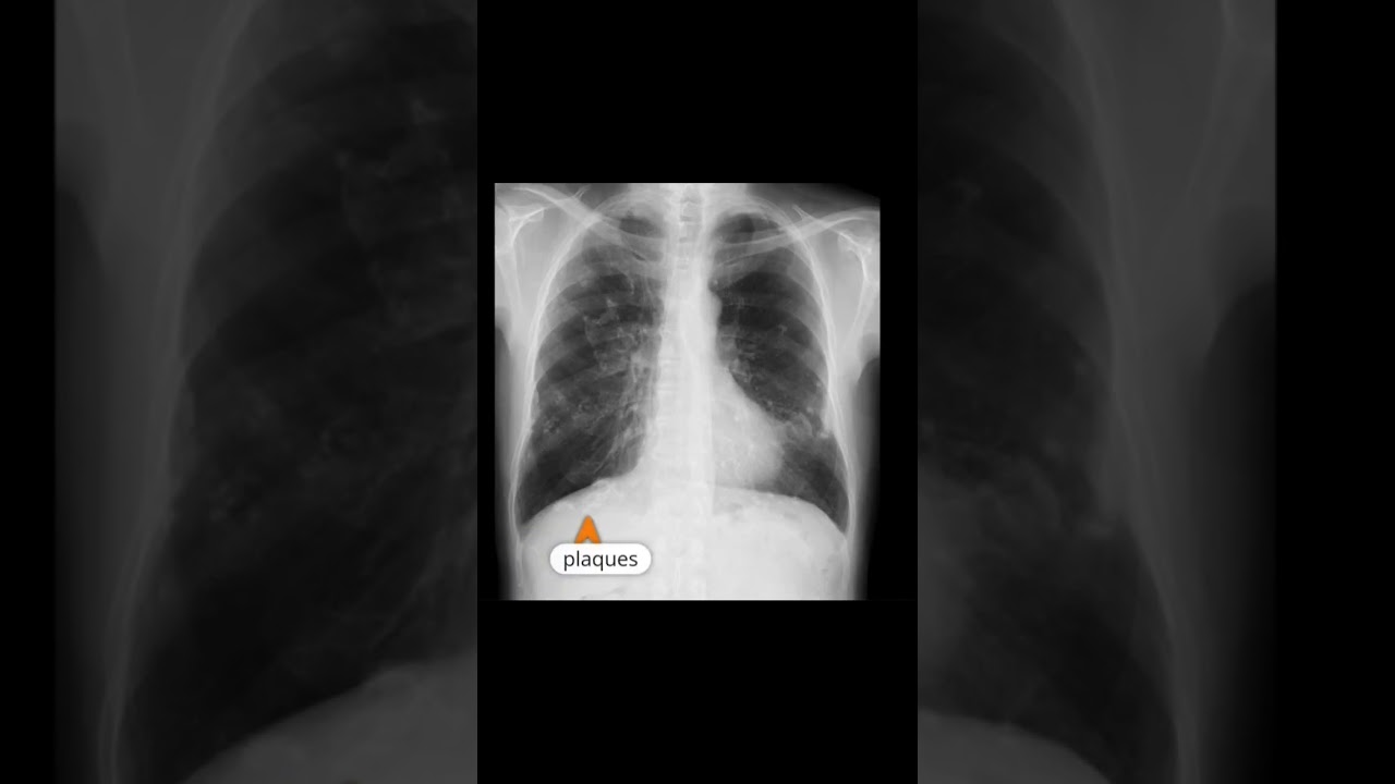 Pleural plaques 