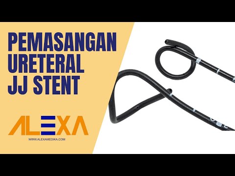 Video: Berapa lama pemasangan stent?