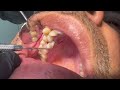 Extraction of supranumerary teeth dental extraction  dental ji