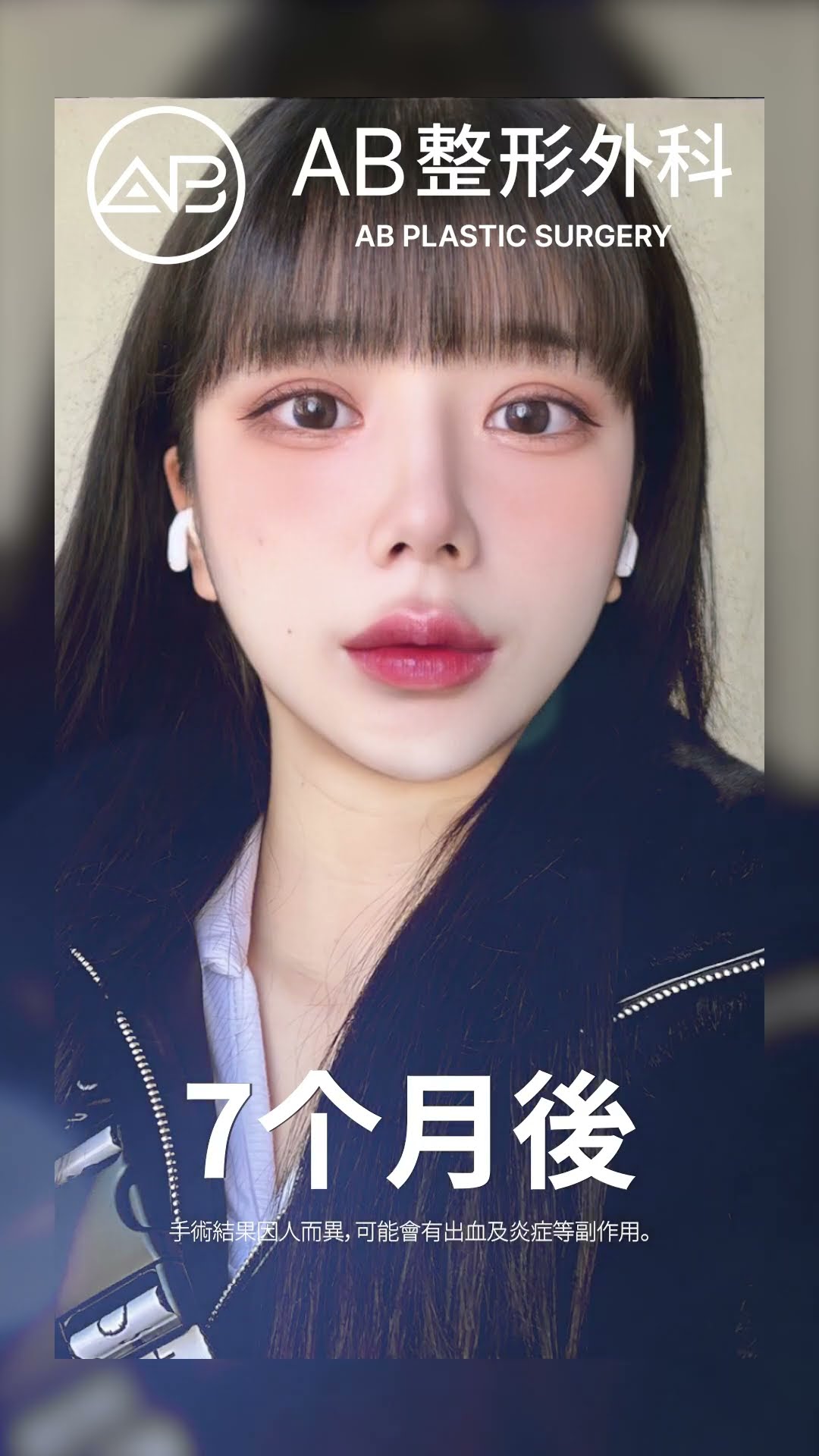 美麗蛻變: 從自然到驚豔的美 | AB整形外科 #短片 #shorts