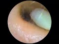 Ear Health Explained | Gentle Cleaning Techniques