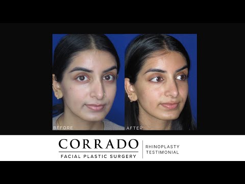 Video thumbnail: Crooked Nose Rhinoplasty Testimonial: "I'm In Love With It" | Dr. Anthony Corrado · Dr. Anthony Corrado