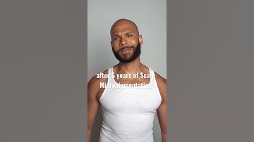What does Scalp Micro-Pigmentation look like after 5 years??