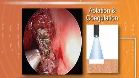Laryngology & Airway - 4 Modes of Operation with the OmniGuide CO2 Laser Fiber