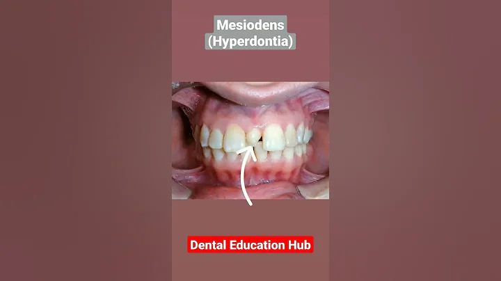 Mesiodens | Supernumerary Tooth - DayDayNews