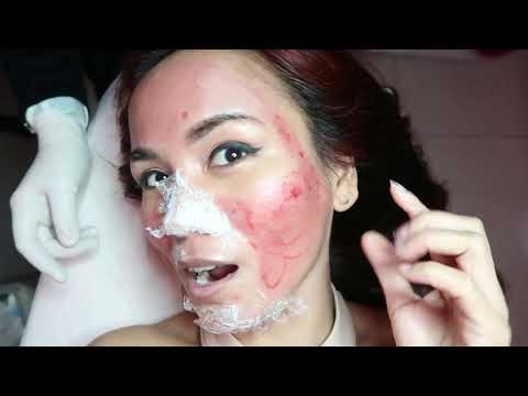 BLOODY FACIAL! | Fractional Needling Therapy (FNT) for ACNE SCARS