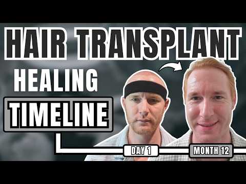 Hair Transplant Healing Timeline (1 Year of Progress + Regrowth)