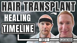 Hair Transplant Healing Timeline (1 Year of Progress + Regrowth)