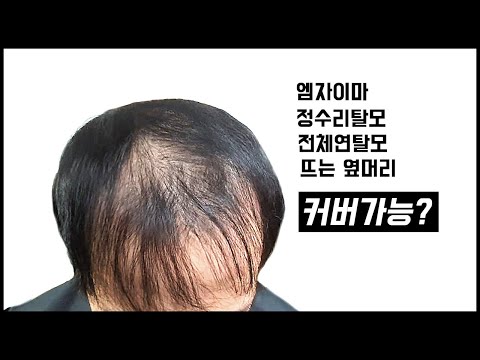 엠자이마 <strong>정수리탈모</strong> 복합탈모를 어느정도 커버를 할수가 있을까?