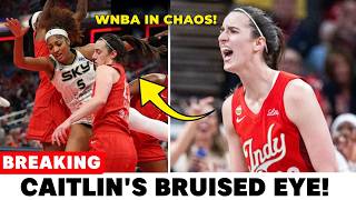 BREAKING: Caitlin Clark Reveals Bruised Eye After Angel Reese Shove | WNBA Fans React