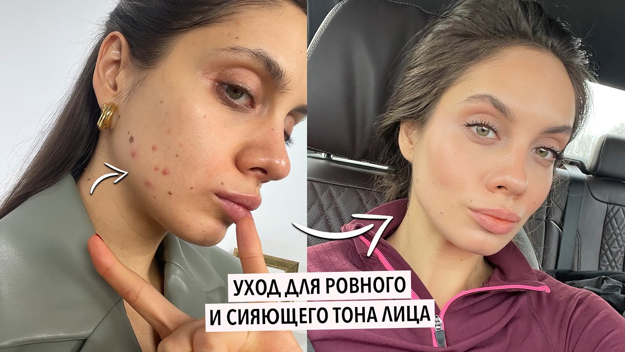 УХОД, КОТОРЫЙ СПАСАЕТ МОЮ КОЖУ | ЭФФЕКТИВНАЯ БОРЬБА С ПОСТАКНЕ