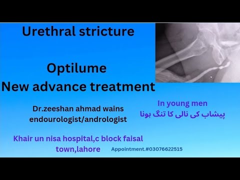 #urethal stricture,new advance