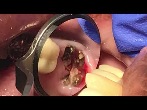 How to extract broken endodontic treated molar by Dr. Loc Q. Huynh, DMD