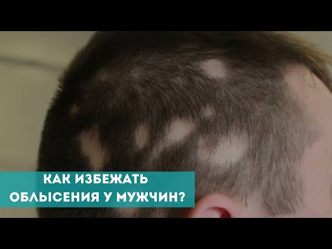 Как избежать облысения у мужчин?