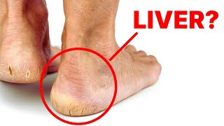 Is Your Liver Crying for Help? Check Your Feet for These Alarming Signs! by Natural Cures 54,010 views 1 month ago 10 minutes, 19 seconds