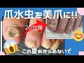 爪水虫を手入れして、ぱっと見美爪にしました！！親孝行ネイル、お父さんの爪水虫を退治したい