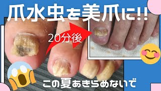 爪水虫を手入れして、ぱっと見美爪にしました！！親孝行ネイル、お父さんの爪水虫を退治したい