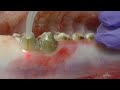 Nv pro3 microlaser procedures  desensitization  debridement  denmat dental education