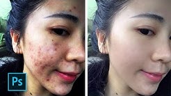 Cara Menghilangkan Jerawat 100% Work - Photoshop Tutorial Indonesia - Durasi: 5.12. Cara Menghilangkan Jerawat 100% Work - Photoshop Tutorial Indonesia - Durasi: 5.12.