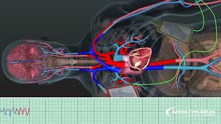 AED in Action   A 3D Look Inside the Body