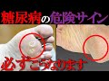 【医師監修】絶対に見逃してはいけない「糖尿病で起きやすい足の危険サイン」