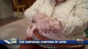 Medical Moment: Five surprising symptoms of lupus