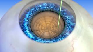 Summit Eye Care | Revolutionizing Eye Care with Femtosecond Laser Assisted Cataract Surgery