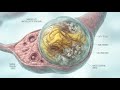 What they don't tell you about ovarian cysts!