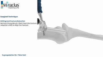 Suprapatellar Nail Surgical Technique