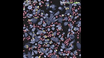 CAR T cell engagement with human pancreatic cancer cells AsPC 1 CAR T 4