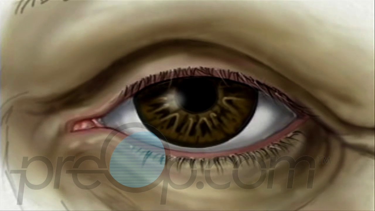 Cataract Surgery - Small Incision PreOp® Patient Education Engagement -  YouTube