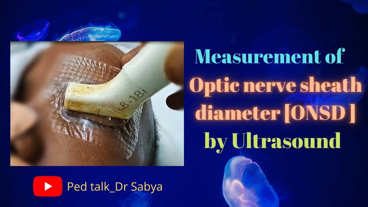 Optic nerve sheath diameter/ measurement of ONSD/ ONSD for papilloedema