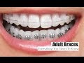 Adult Braces, Everything You Need To Know!-  MissLizHeart