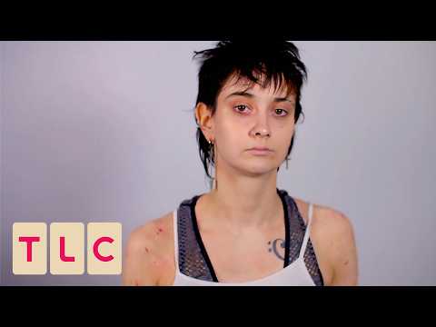 Woman Diagnosed With Eczema After 25 Years! | The Bad Skin Clinic