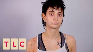 Woman Diagnosed With Eczema After 25 Years! | The Bad Skin Clinic