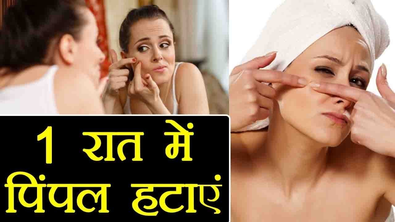 रातोरात कील मुहासों को गायब करने का जबरदस्त घरेलु नुस्खा // Pimples Ka