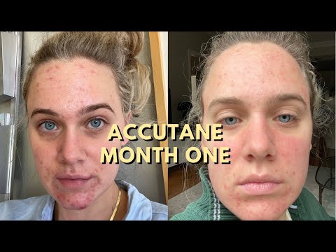 ACCUTANE JOURNEY Month 1 | Because Acne Sucks
