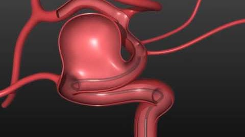 EV3 Pipeline Embolization Device