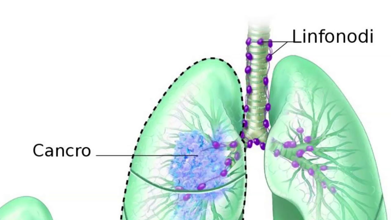 Intervista al Dr. Carlo Curcio (Responsabile Chirurgia Toracica Monaldi)