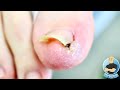HIS NAIL LEFT DAMAGED, DESTROYED, LIFTED AND STILL INGROWN ***Multiple Failed Nail Surgeries***