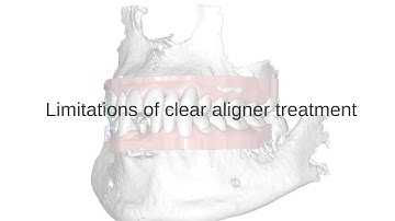 Introduction. Limitations of aligners. My lecture from 2020 - Part 1.