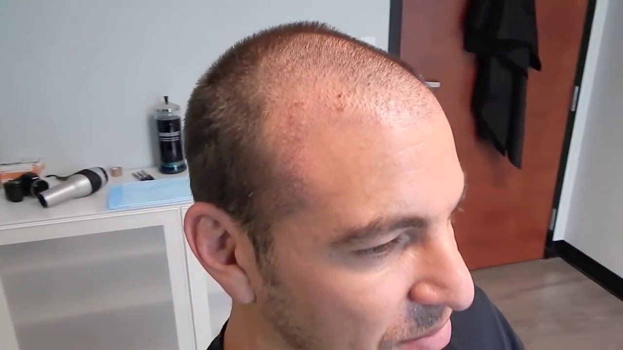 Natural Transplants What does hair restoration cost near Orlando YouTube