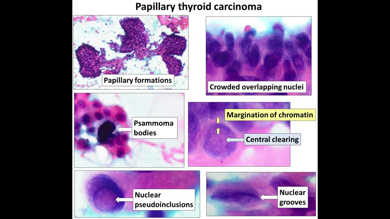 Thyroid Cancer Types