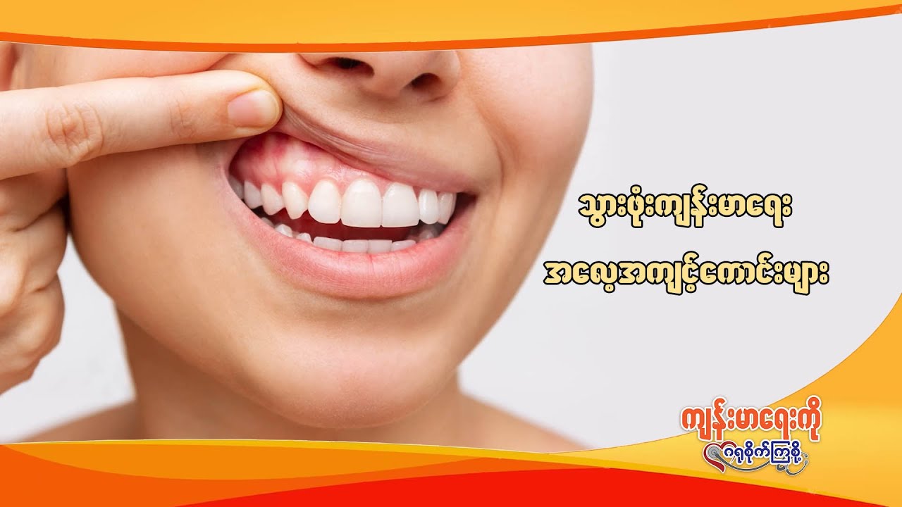 ကျန်းမာရေးကိုဂရုစိုက်ကြစို့ - အပိုင်း (၁၂) - သွားဖုံးကျန်းမာရေး