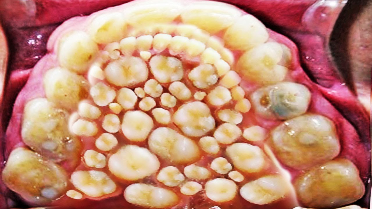 2016 World Record for Most Teeth &amp; Hyperdontia! - YouTube