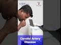 Carotid Artery Disease: Causes, Risks, and How to Protect Your Brain