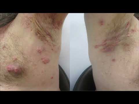 Hidradenitis! Painful Lumps Under the Skin