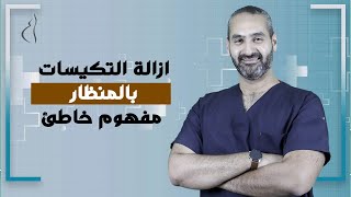 ازالة التكيسات بالمنظار مفهوم خاطئ